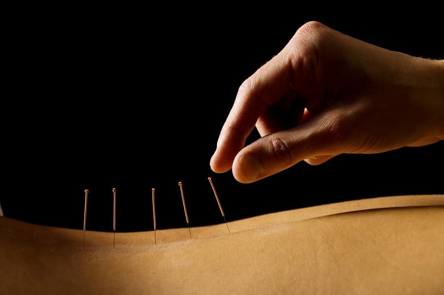 acupuncture