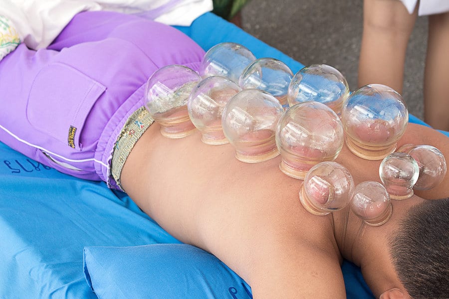 cupping