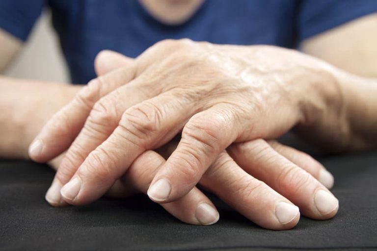 Rheumatoid arthritis acupuncture